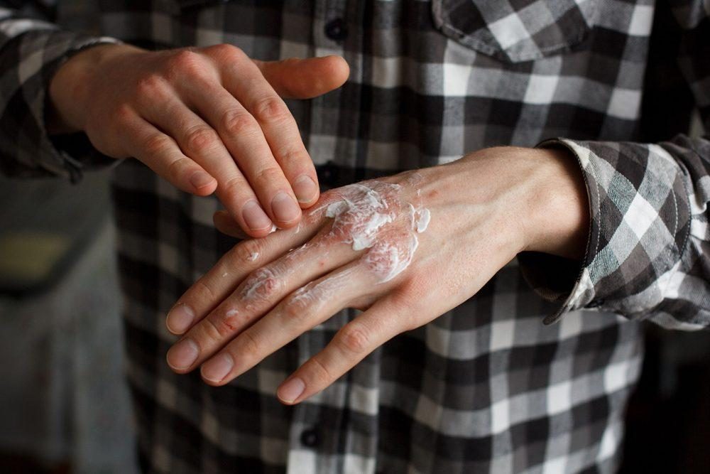 Diabetic man rubs cream on diabetic dry skin