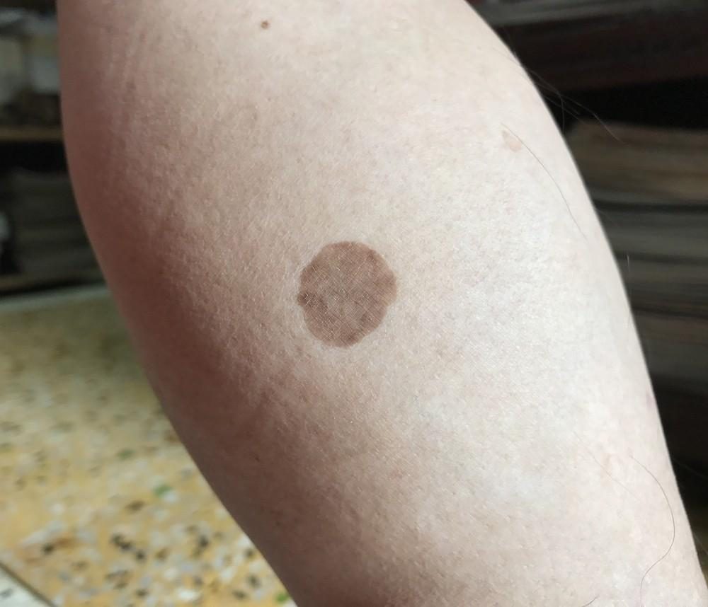 What Is Diabetic Dermopathy