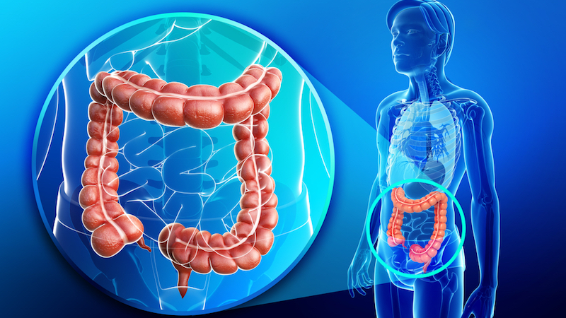 What Is Colorectal Cancer and How Can You Lower Your Risk?