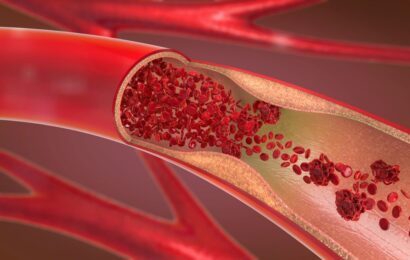 Image of a blood vessel representing cholesterol levels and diabetes